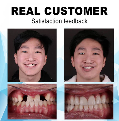 Dobshow ™ Silicone Reline Denture Set (⏰Limited time discount Last 30 minutes⏰)